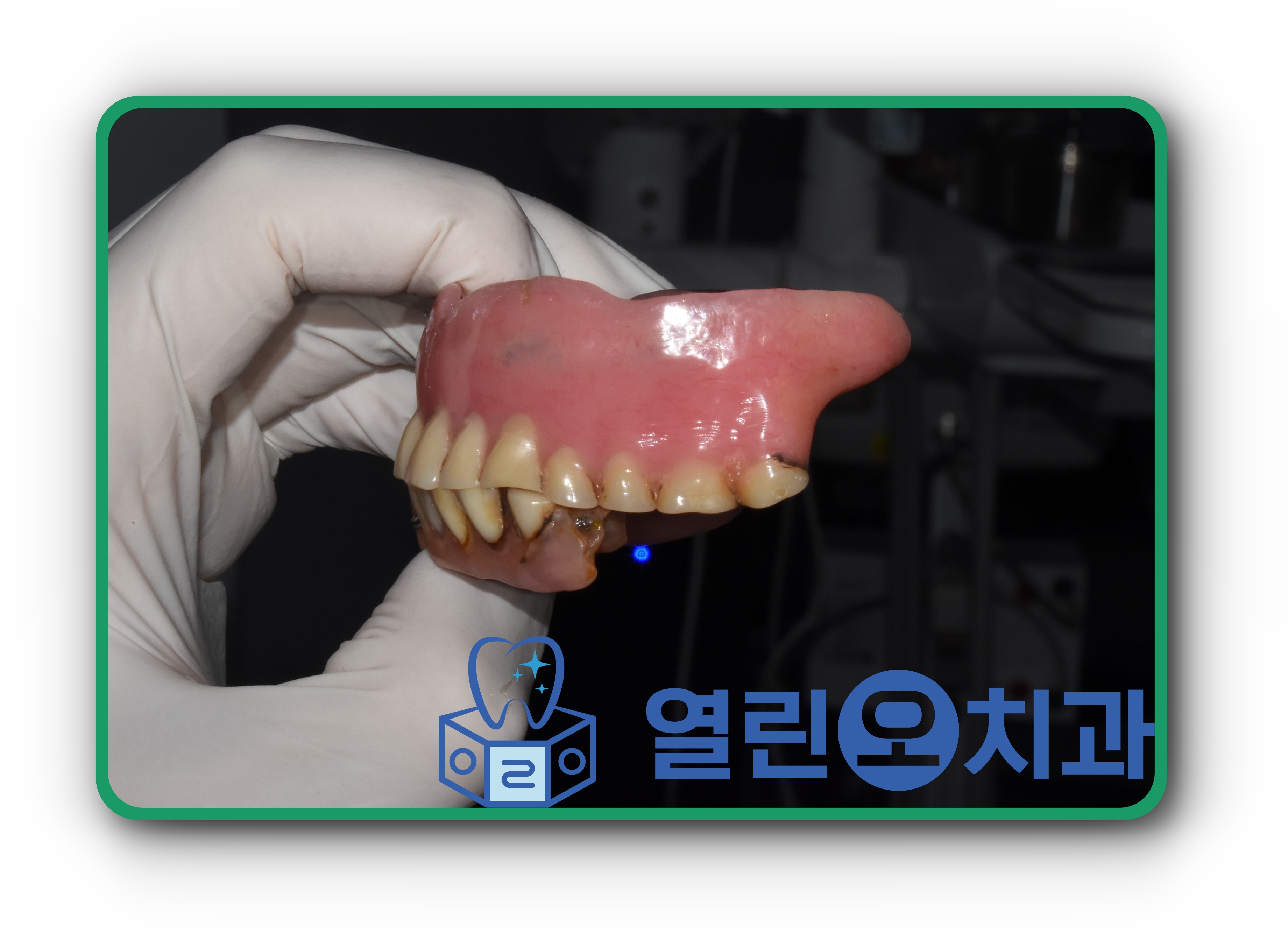 치료전, 좌측