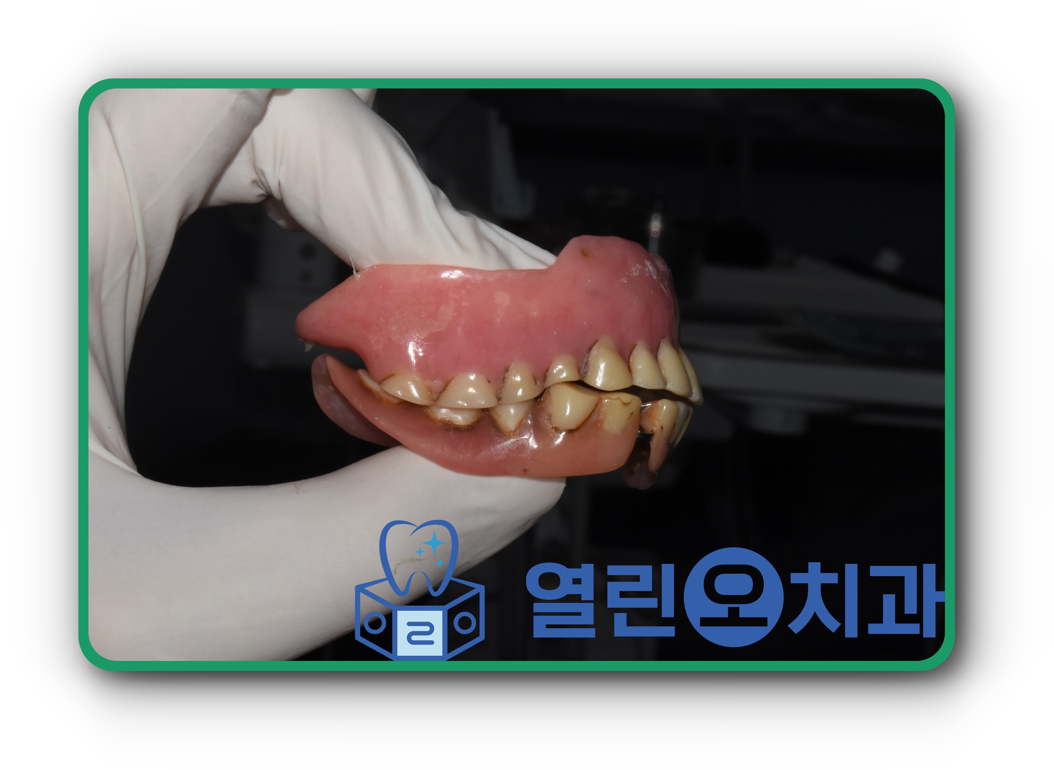 치료전, 우측